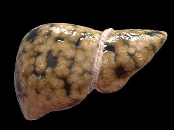 A liver showing hidden fat.